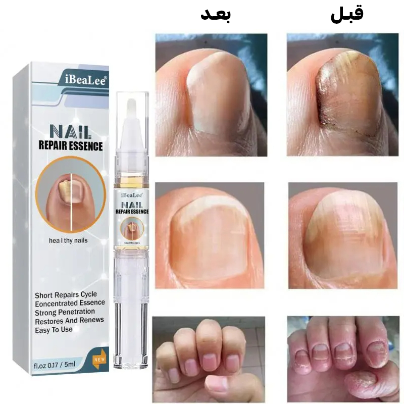 العلاج النهائي لمشاكل فطريات الأظافر
