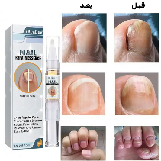 العلاج النهائي لمشاكل فطريات الأظافر